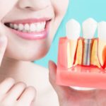Implante Dentário Pelo SUS - Como Conseguir