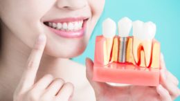 Implante Dentário Pelo SUS - Como Conseguir